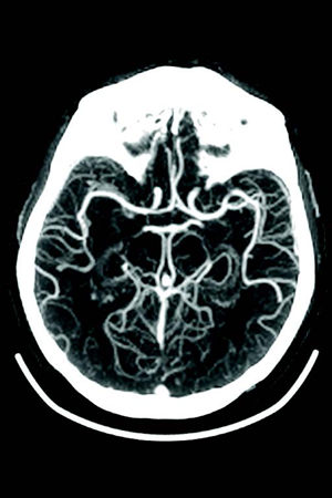 BodyTom® | Portable Full Body CT | NeuroLogica - Samsung