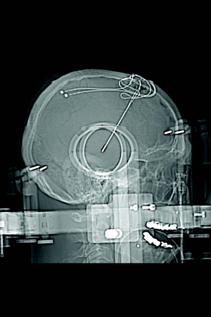 BodyTom® | Portable Full Body CT | NeuroLogica - Samsung