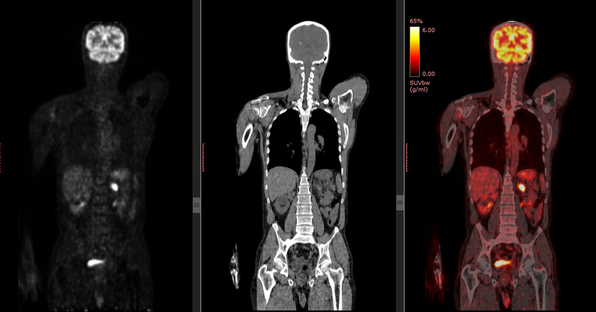 Medicare Pet Scan Coverage 2024 Anetta Magdaia